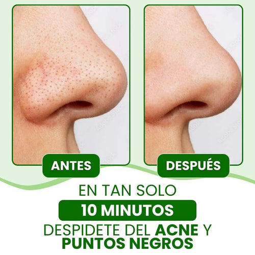 (Oferta especial) 🎁 Lanbena®: Mascarilla avanzada para puntos negros